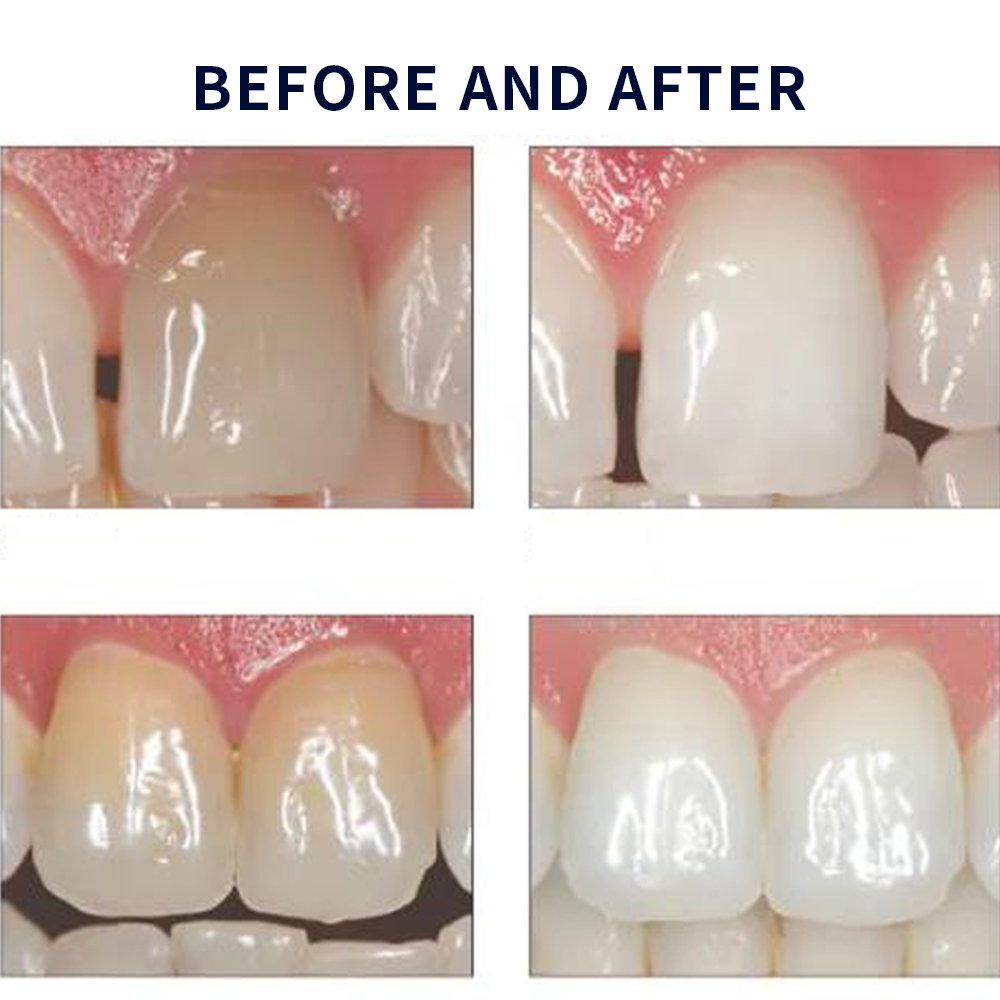 20% pF 20 16ชุดเจล8x1.2มล. ชุด - Teeth Whitening Near Me บทวิจารณ์และราคา