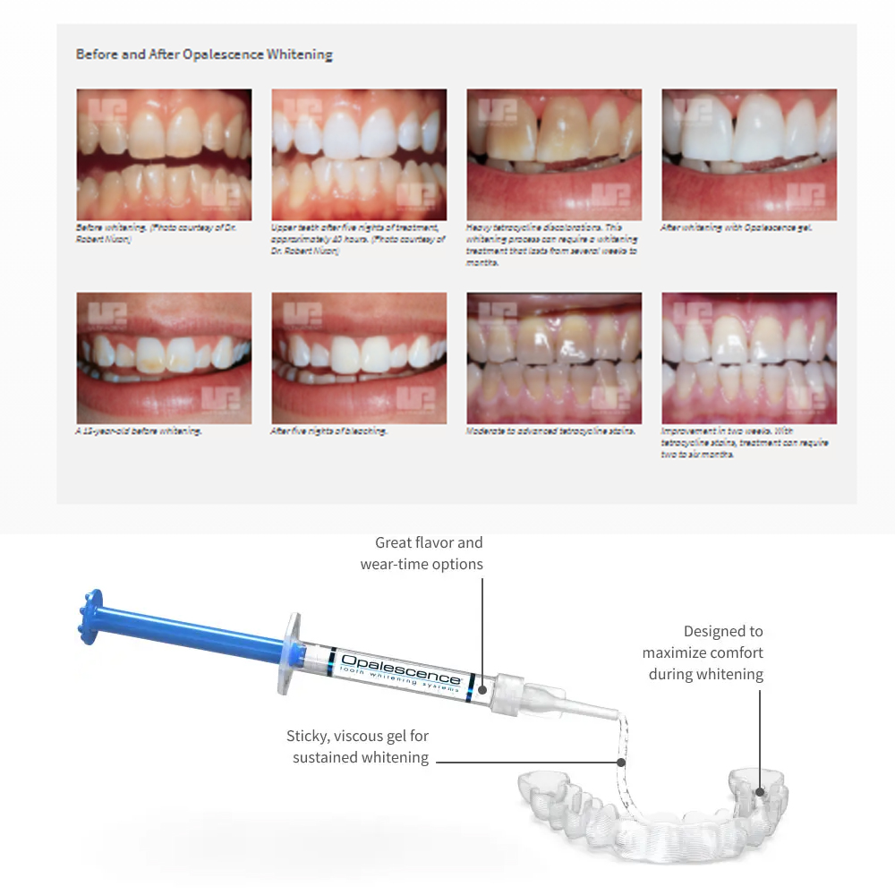 20% pF 20 16ชุดเจล8x1.2มล. ชุด - Teeth Whitening Near Me บทวิจารณ์และราคา